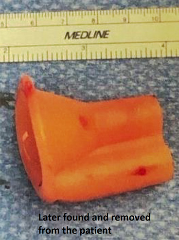 Foreign object removed from patient